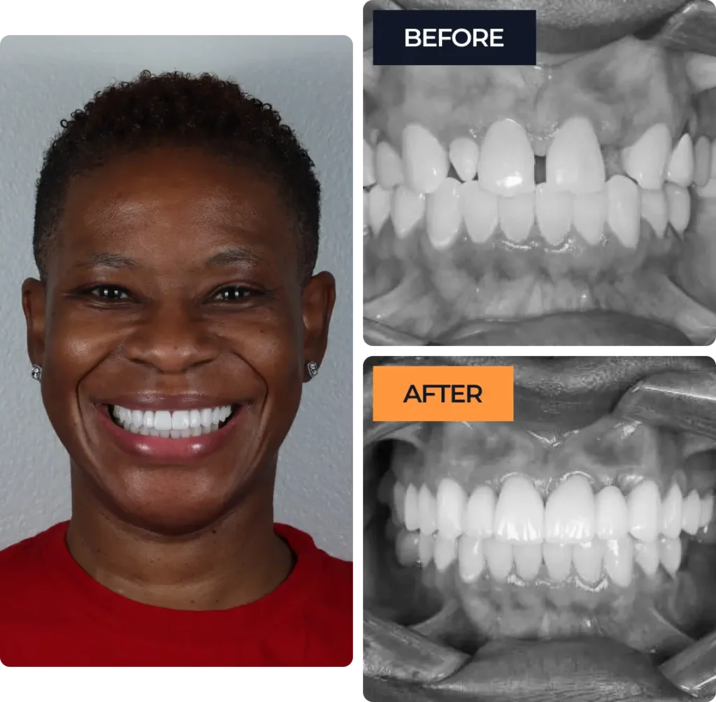 Detailed comparison of a smile makeover: clinical "Before" shots showing tooth spacing and "After" shots featuring a perfectly aligned, bright white smile with porcelain veneers on a happy female patient.